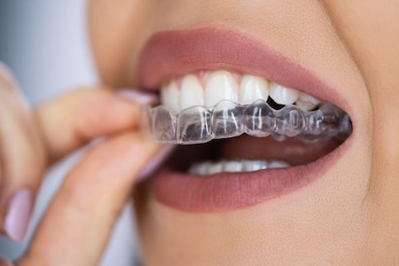 woman with invisalign