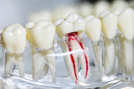 An endodontist showing how long does root canal takes.