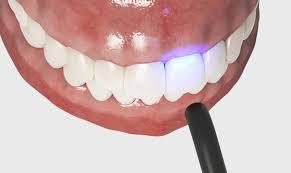A dentist demonstrates how dental bonding and white fillings appear after the procedure.