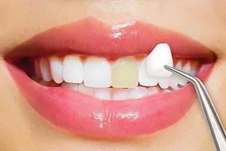 A clear difference between white tooth bonding and dental filling.