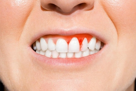 Close-up of bleeding gums between front teeth, showing signs of gingivitis.