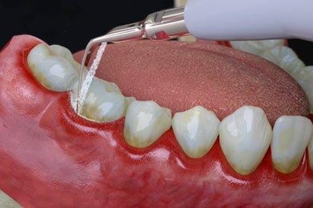 Dental scaling procedure on inflamed gums, treating plaque buildup caused by periodontal disease.