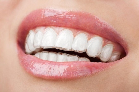 A visual representation of Invisalign invisible braces for teeth.