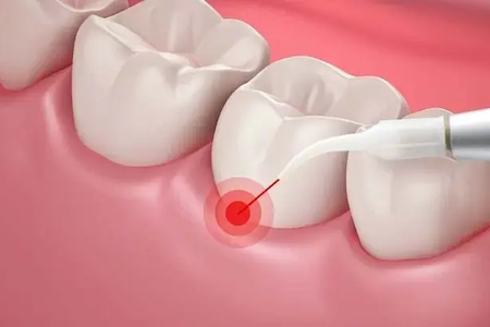 A LANAP & LAPT laser treatment at the Aliso Creek dental.