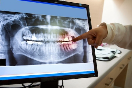 A dental surgeon in Aliso Viejo is discussing the surgical procedure with her patient.