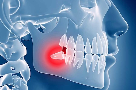 An image showing an impacted wisdom tooth removal scan.