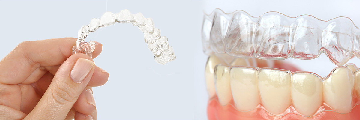 Aliso Viejo Alternative to Braces for Teens