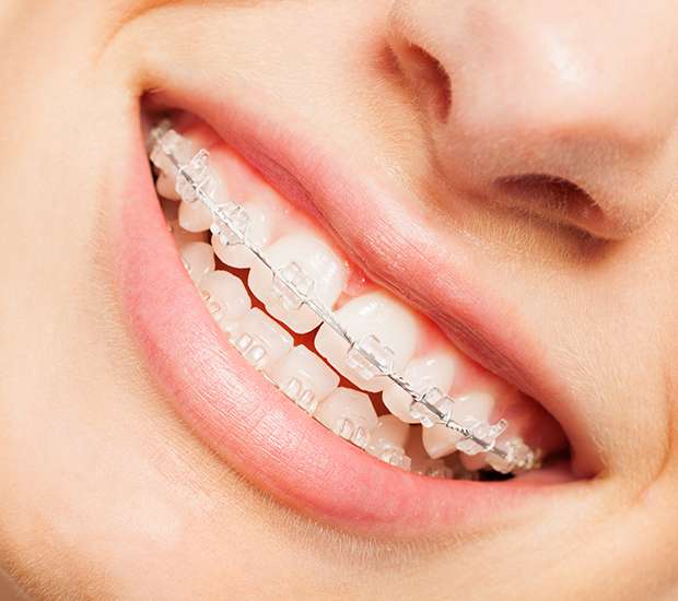 Aliso Viejo Invisible Orthodontics