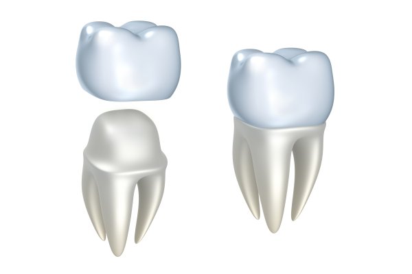 Dental Implants Aliso Viejo, CA