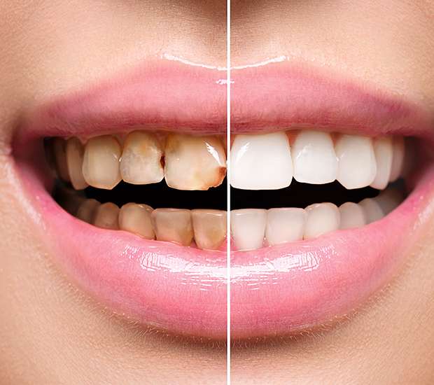 Aliso Viejo Dental Implant Restoration