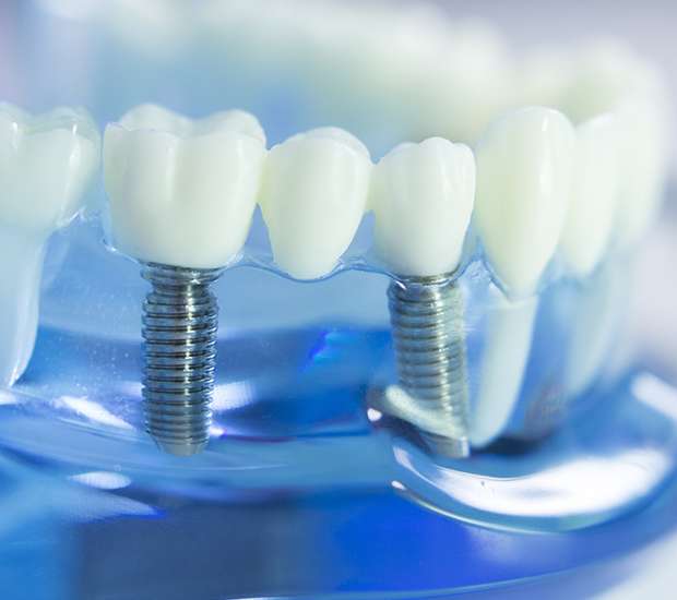 Aliso Viejo Dental Prosthetics