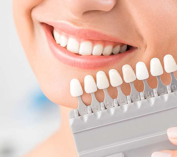 Aliso Viejo Veneers