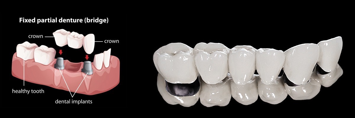Aliso Viejo Dentures