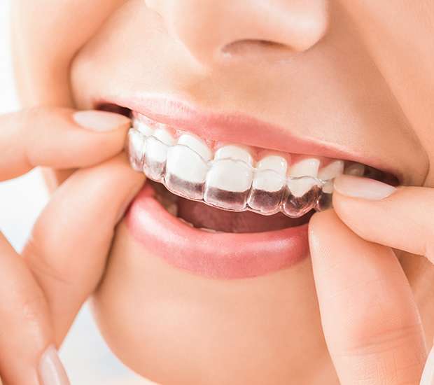Aliso Viejo Does Invisalign® Really Work?