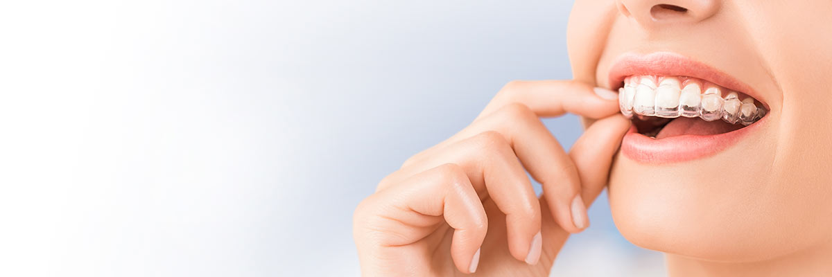 Aliso Viejo Invisalign Dentist