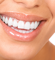 Teeth Whitening Services Aliso Viejo, CA