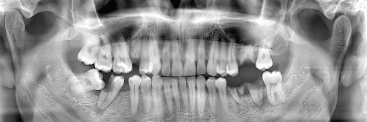 Aliso Viejo Wisdom Teeth Extraction